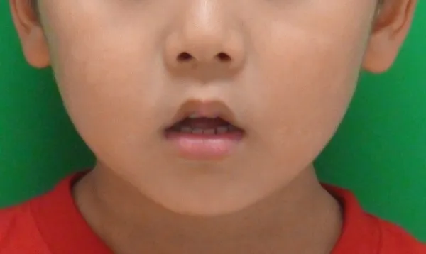 口呼吸