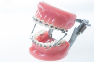 歯並びが悪くなる原因とリスク